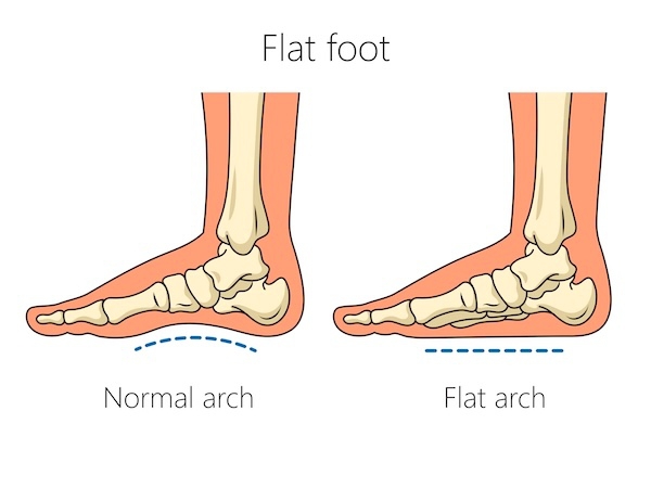 Flat Feet