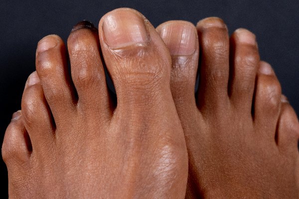 Foot Deformities